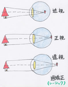 後遺症 レーシック